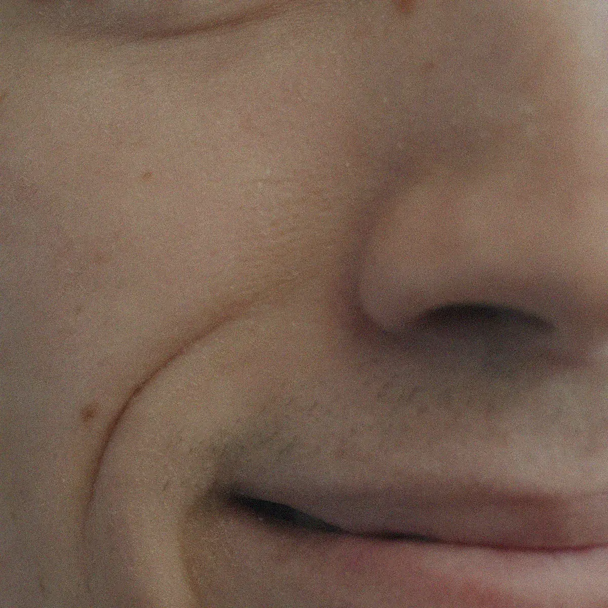 Fine lines around the eyes, before